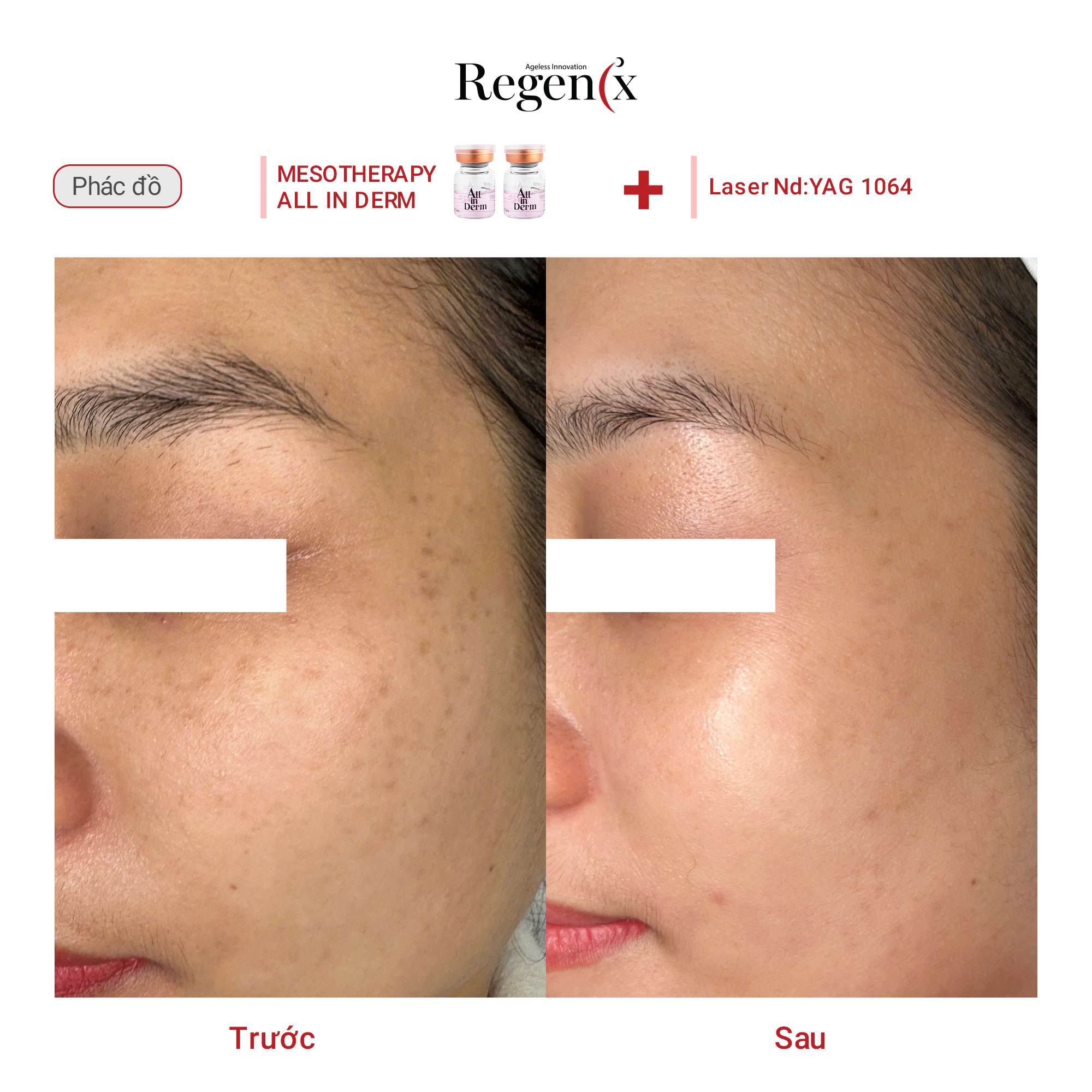 ALL IN DERM - TRẺ HÓA TRẮNG SÁNG CĂNG BÓNG DA - Ảnh 3